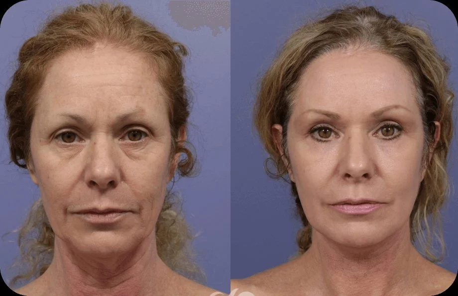 Customer before and after using Synevra - Results may vary